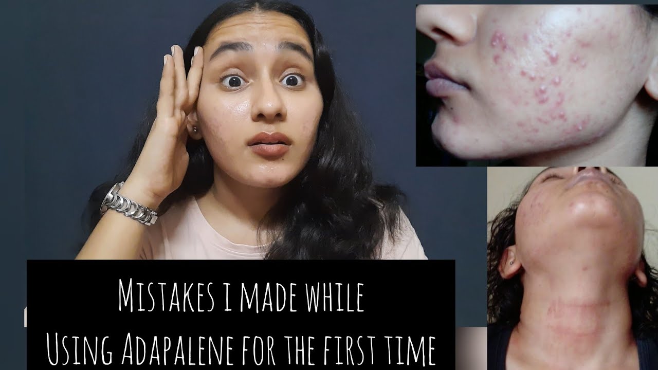 My Adapalene mistakes| Using too much product | Irritation,redness,dry skin| Khushi Mahla
