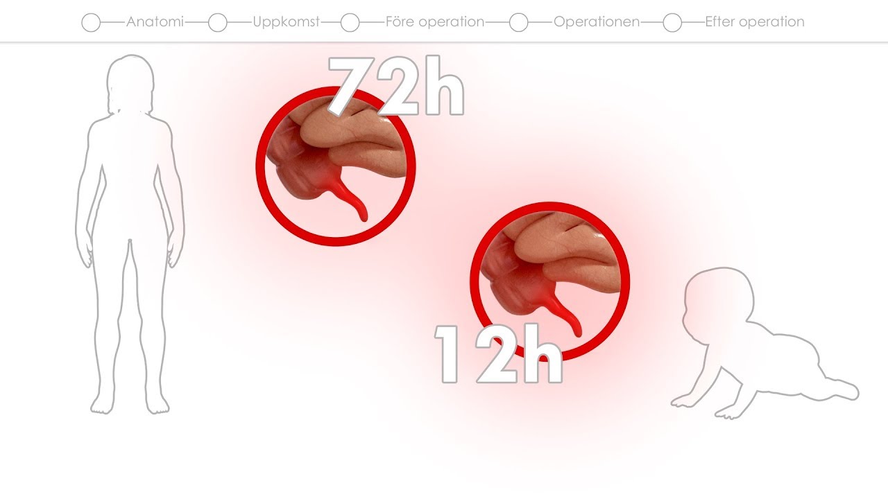 Patientfilm om blindtarmsoperation