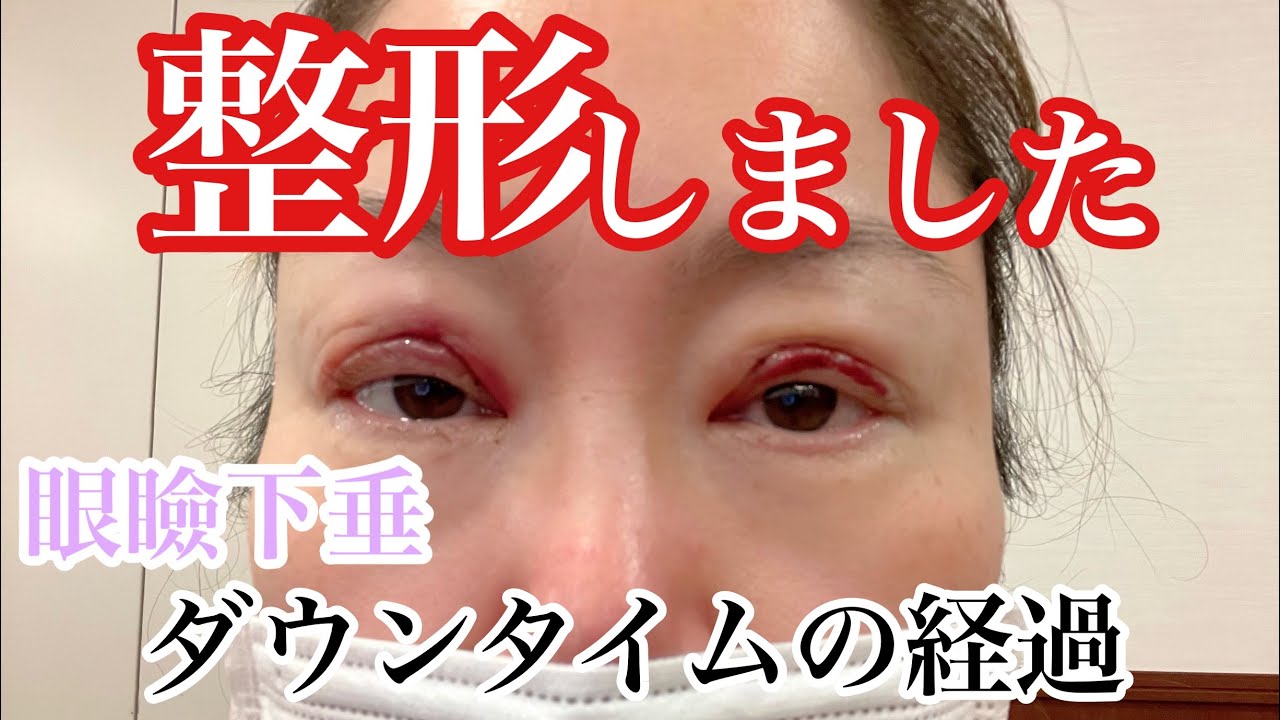 整形しました(眼瞼下垂ダウンタイムの経過１週間)