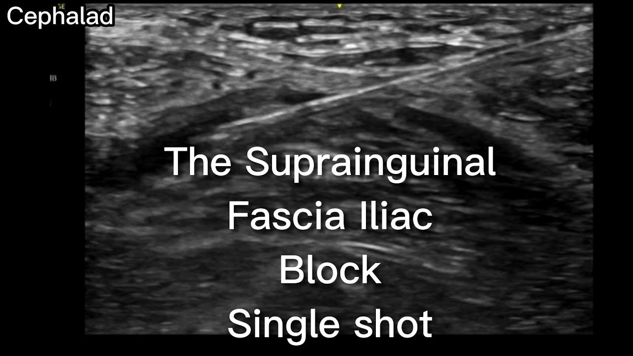 The Suprainguinal Fascia Iliac Block in the Emergency Department
