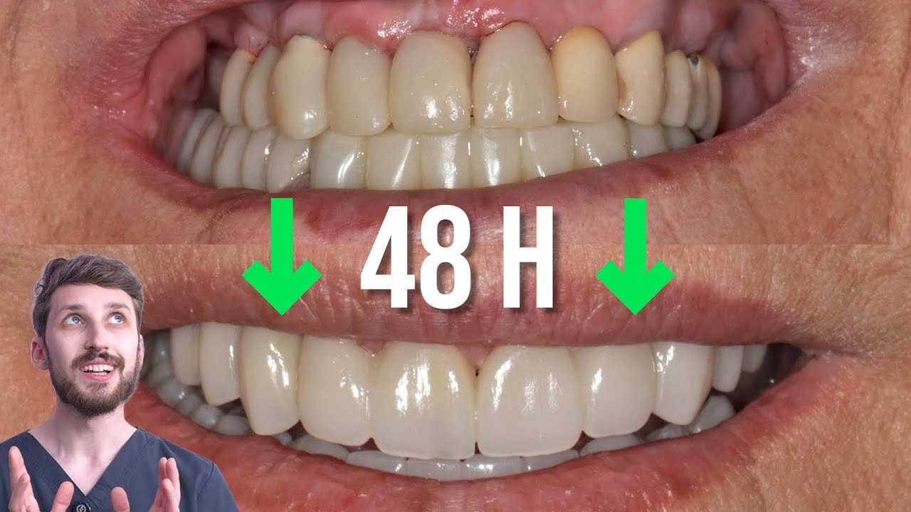 Complete smile transformation - full mouth, full digital workflow