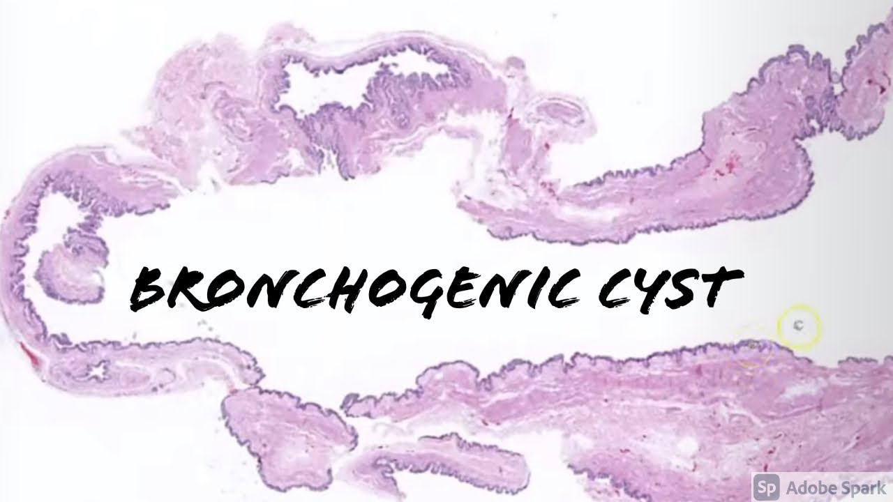 Bronchogenic Cyst: 5-Minute Pathology Pearls