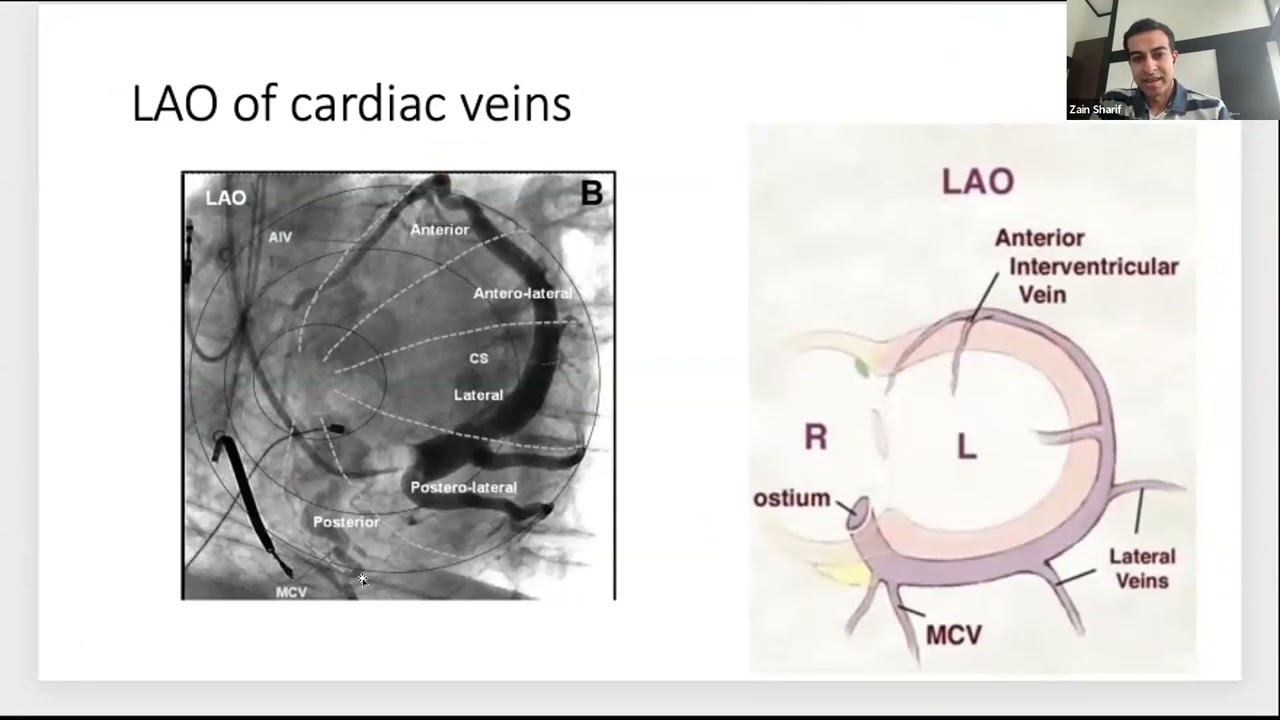 CRT LV Lead Placement - Dr. Zain Sharif & Dr. Ijeoma Ekeruo - SSA CRM