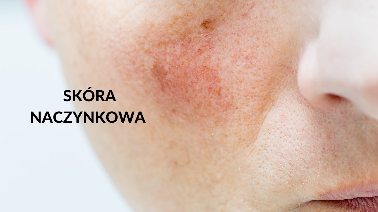 Skóra naczynkowa. Jak zmniejszyć uciążliwy rumień?