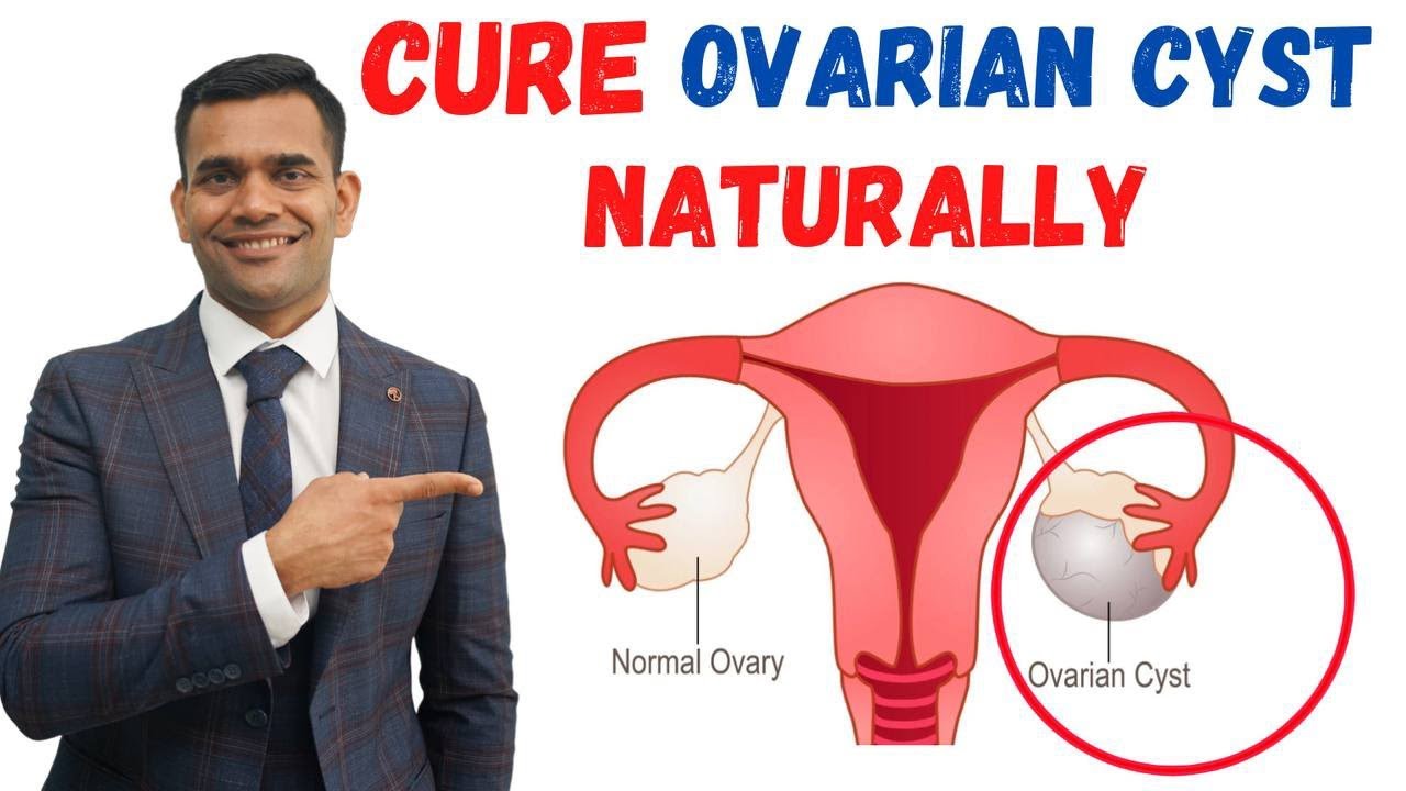 Just 3 Recommendations To Cure Ovarian Cyst Naturally - Dr. Vivek Joshi