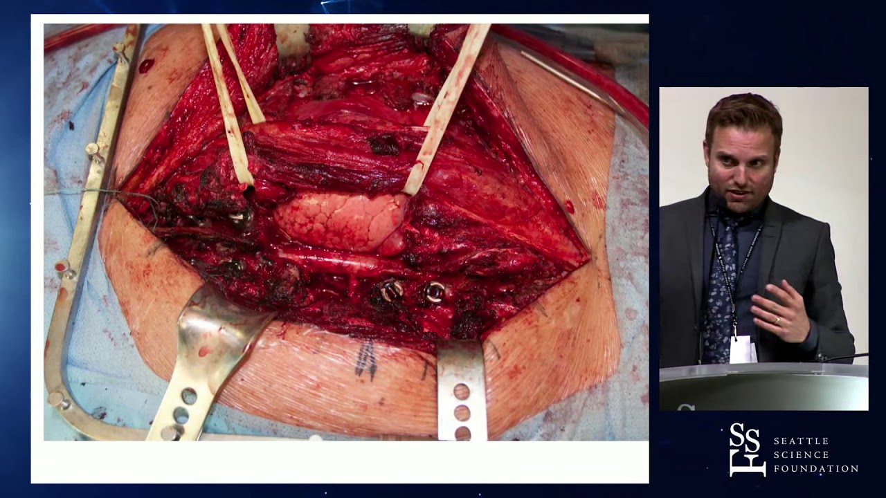 Quality of Life in Patients with Spine Tumors - Nicolas Dea, MD, MSc