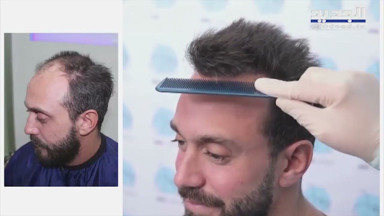 حقائق ومعلومات مهمة يجب معرفتها قبل التخطيط لزراعة الشعر مع دكتور إبراهيم جباعي!