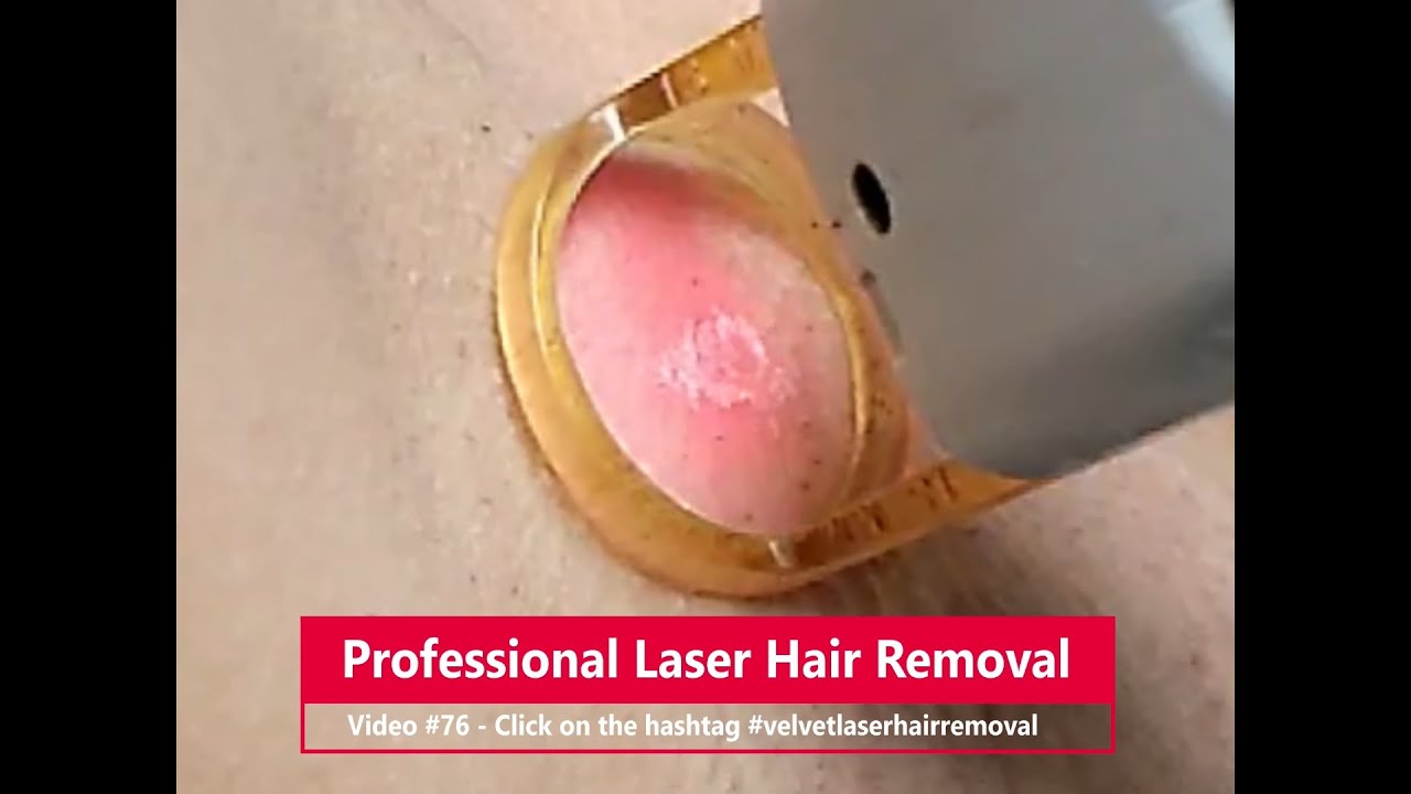 Professional Laser Hair Removal * Underarms * Video #76