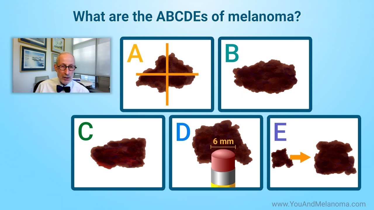 What are the signs and symptoms of melanoma?