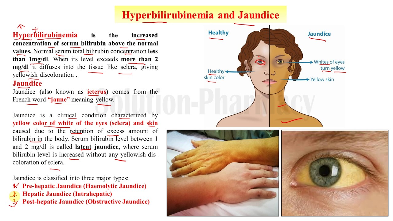 (57) Hyperbilirubinemia and Jaundice | Types and Causes of Jaundice | Classification of Jaundice