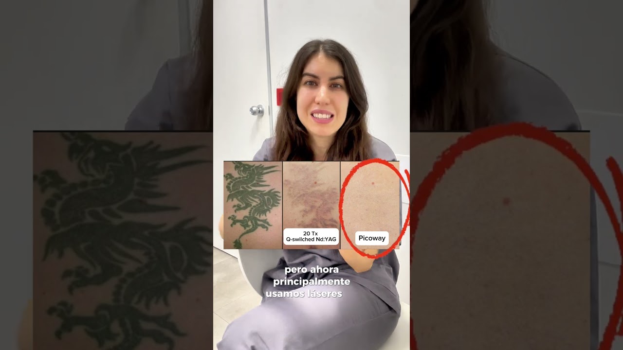 El MEJOR l&aacute;ser para borrar tatuajes &iquest;Picoway o nanosegundos? 🔥💥  #parati #picoway #tatuaje