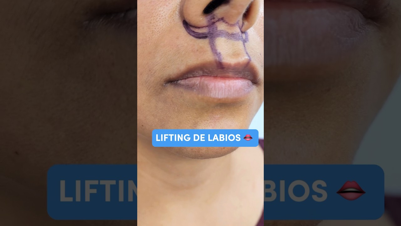 Lifting de labios.