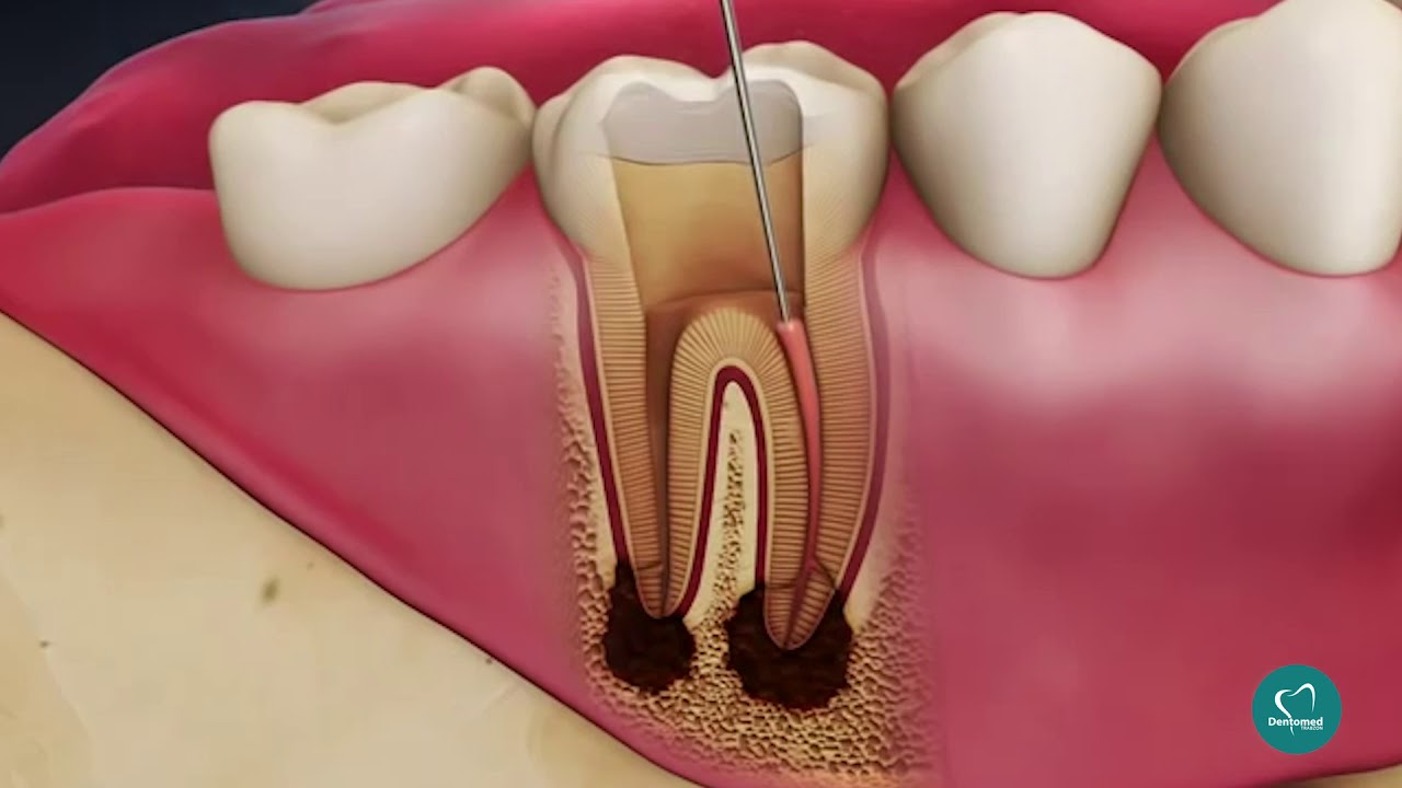 📹 KANAL TEDAVİSİ NASIL YAPILIR?