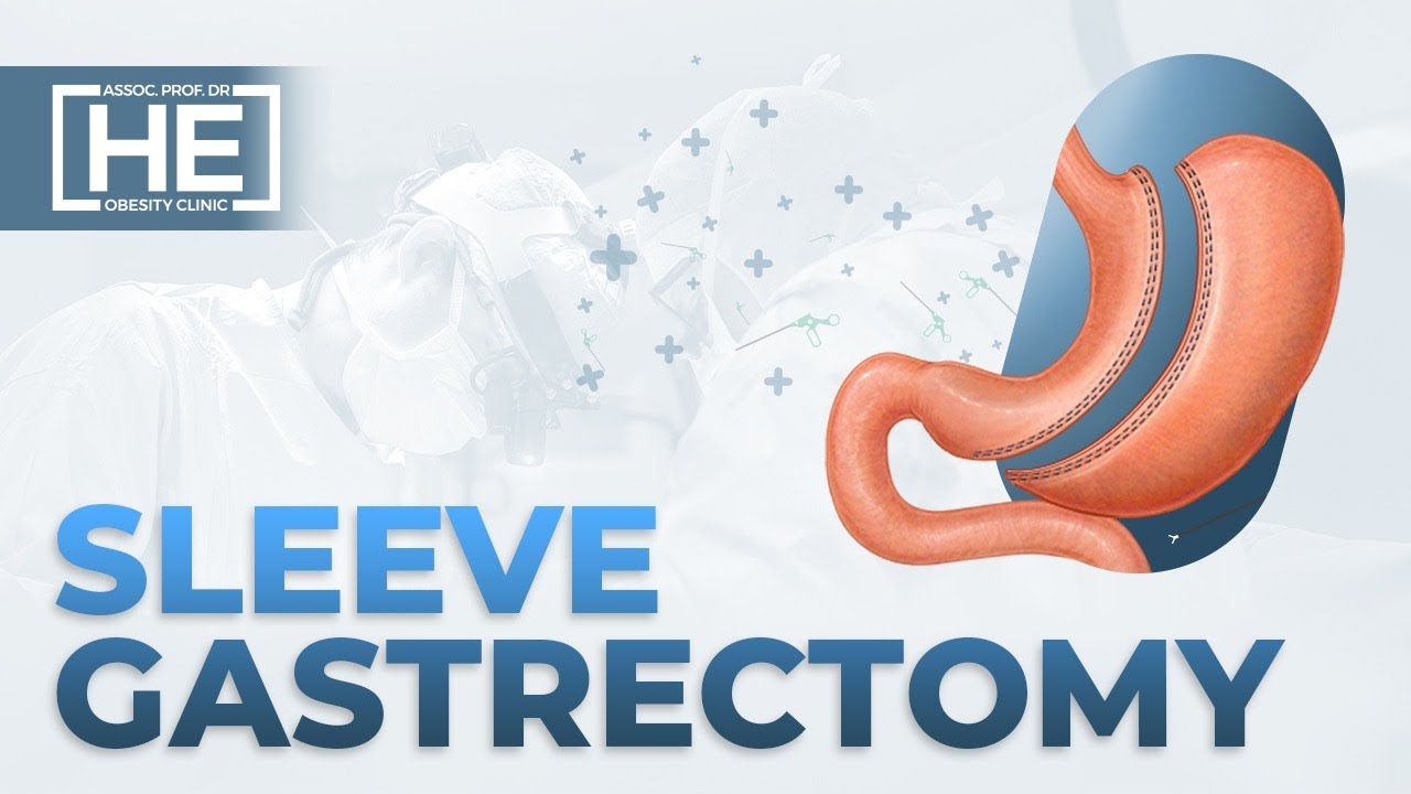 Gastric Sleeve Turkey | Laparoscopic Sleeve Gastrectomy Animation - Weight Loss Surgery in Turkey