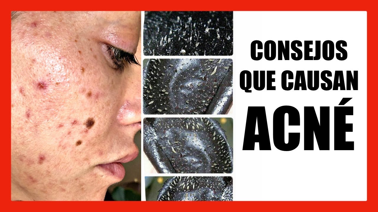 🚫 5 ERRORES caseros que CAUSAN ACNÉ ➡️ [EVITA ESTO‼️]
