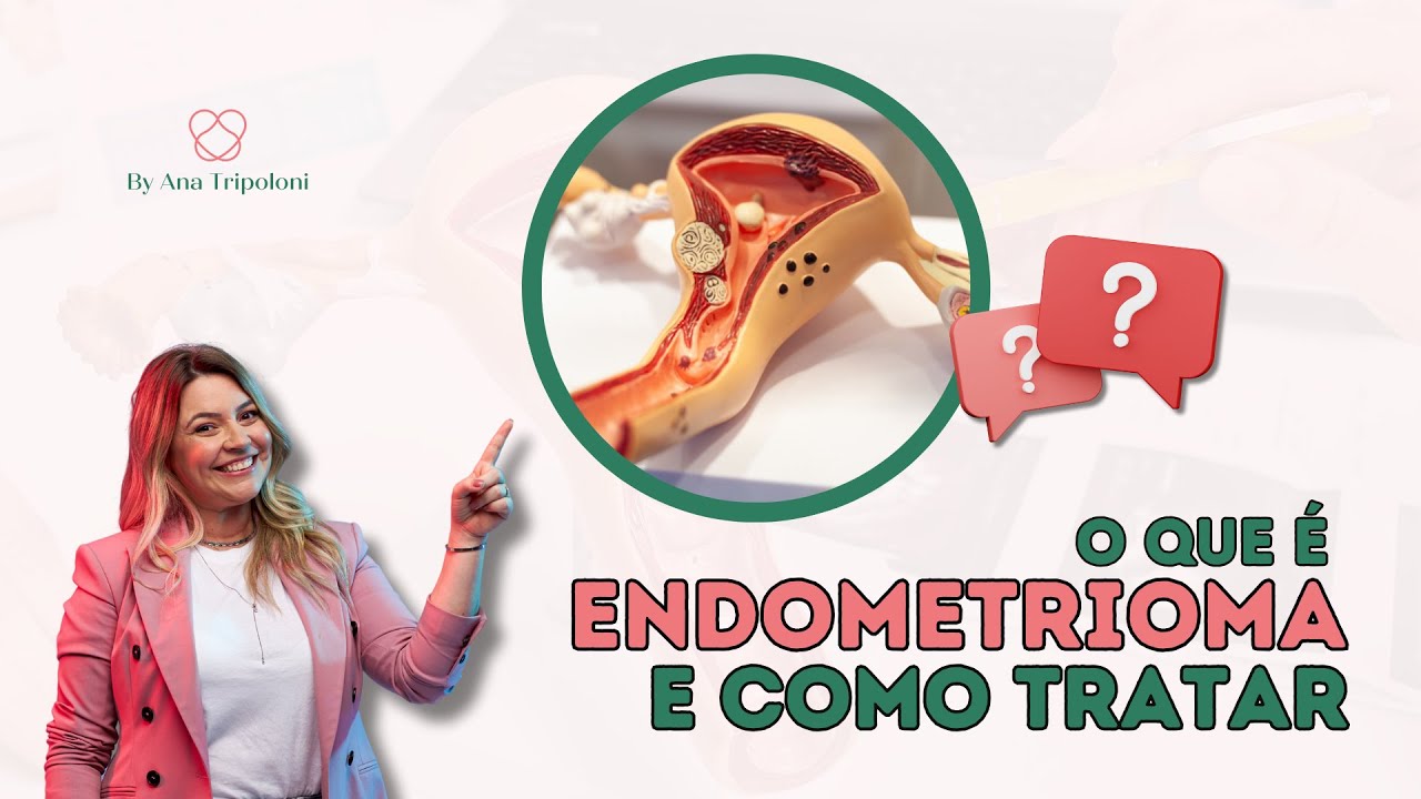 O Que é Endometrioma e Como Tratar | Ana Tripoloni #11