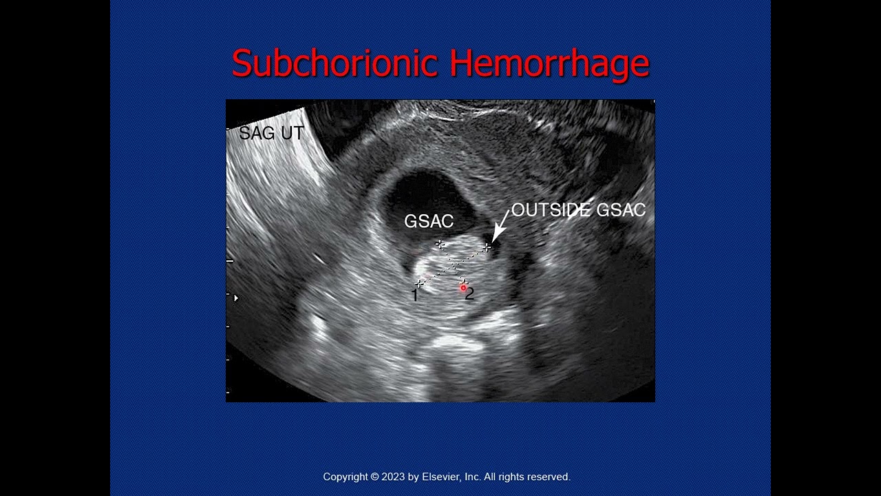 1st Trimester Complications