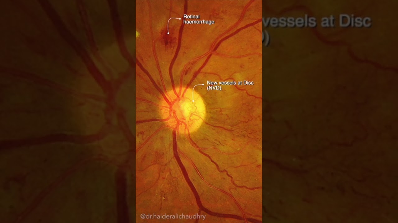 Proliferative Diabetic Retinopathy | #Shorts