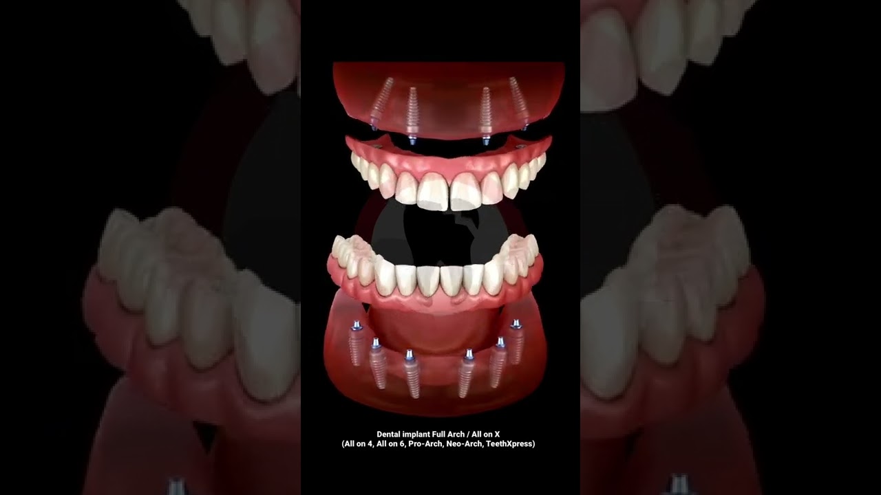 Dental Implant Full Arch / All on X ( All on 4, All in 5, All on 6, Pro-Arch, Neo-Arch, TeethXpress)