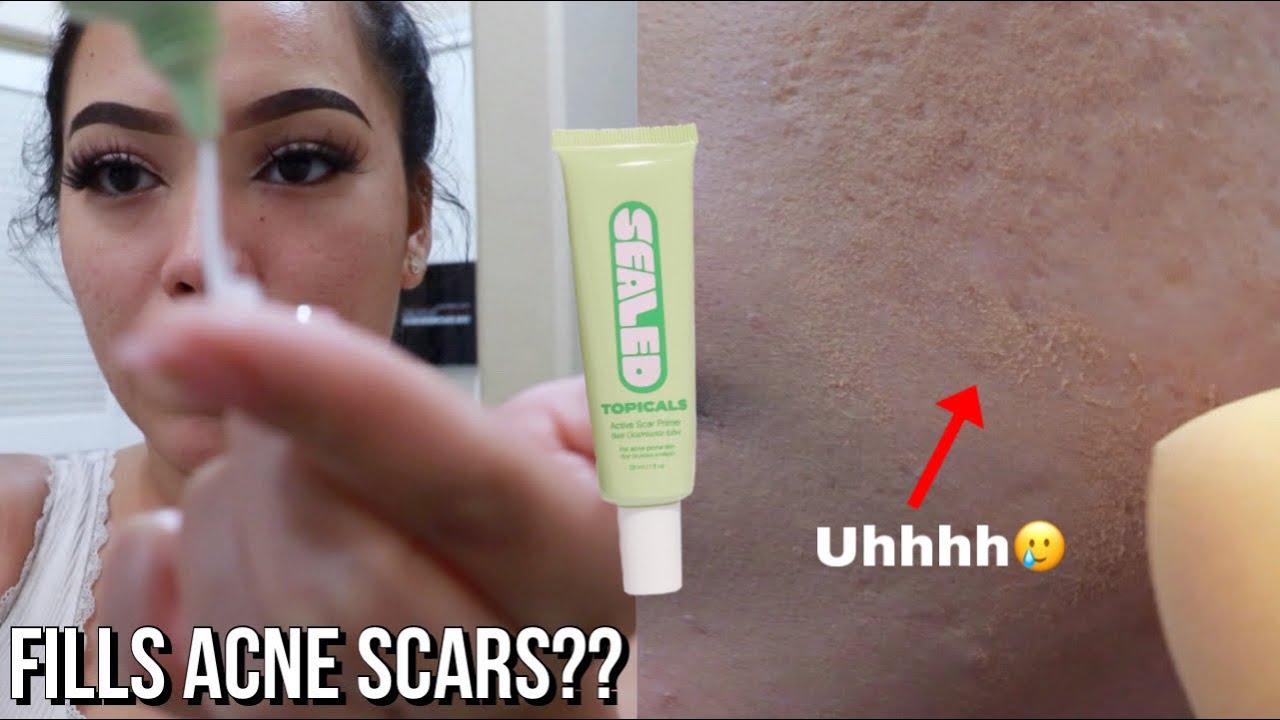 Topicals Sealed Primer | First Impression | The best primer for deep acne scars?