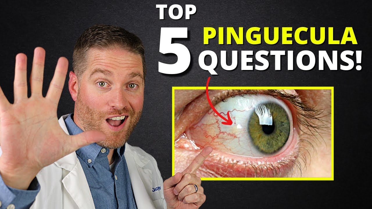 Yellow Spot On Your Eye (Pinguecula) - Top 5 Questions Answered!
