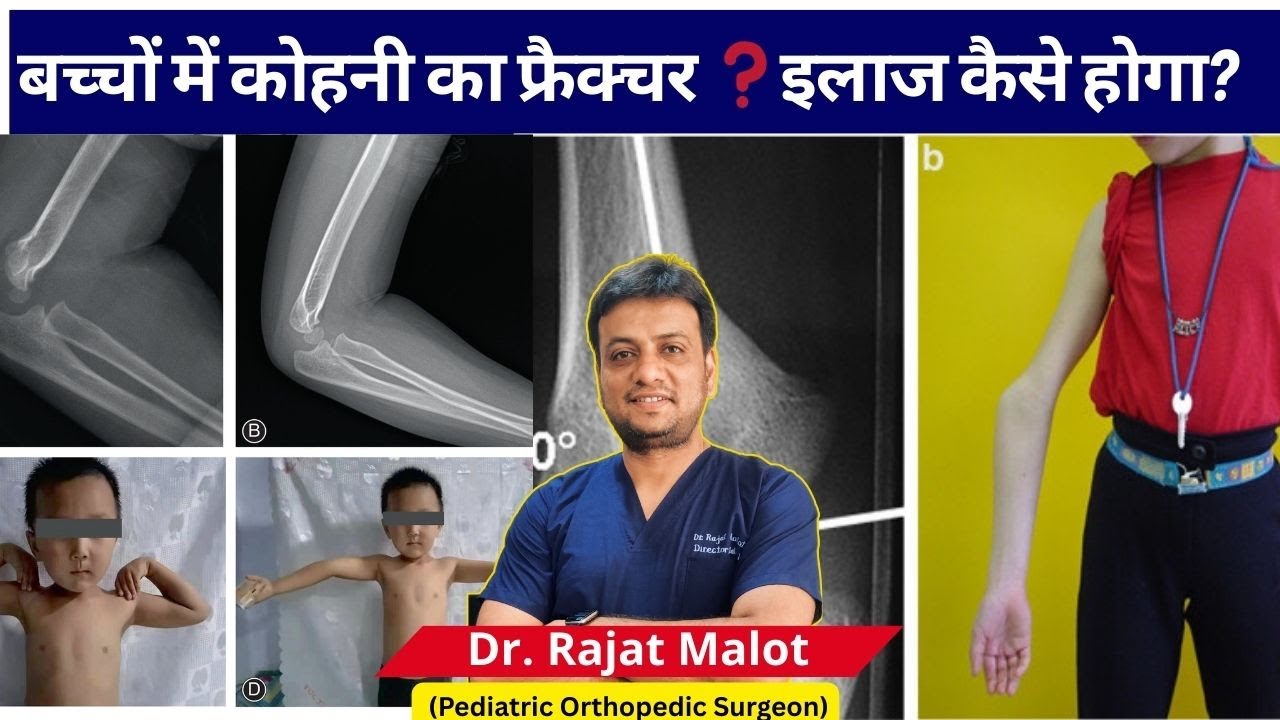 बच्चों में Lateral Condyle Fracture  कोहनी के फ्रैक्चर का इलाज कैसे होता है  Dr  Rajat Malot Explain