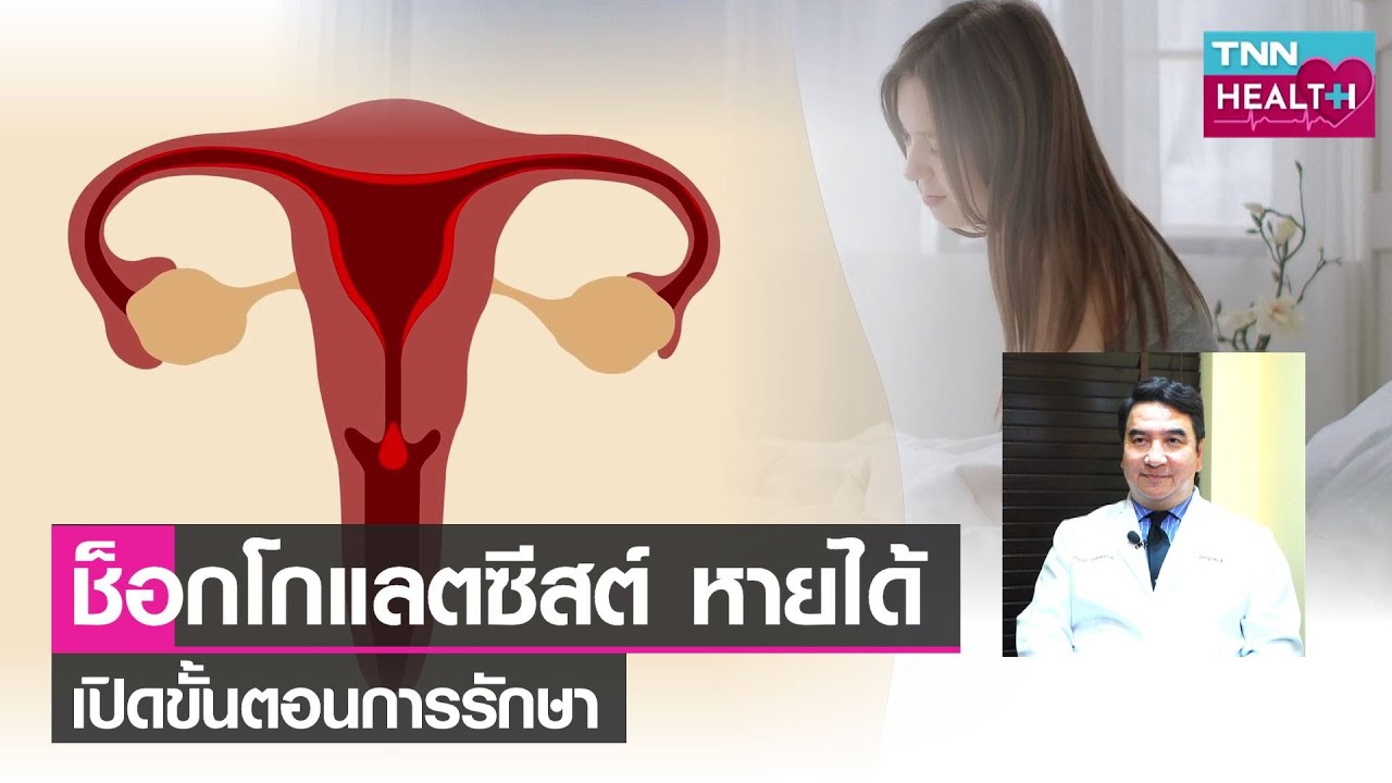 เปิดขั้นตอนการรักษา“ช็อกโกแลตซีสต์”ด้วยเทคโนโลยีทางการแพทย์ยุคใหม่ l TNN HEALTH l 17 09 65