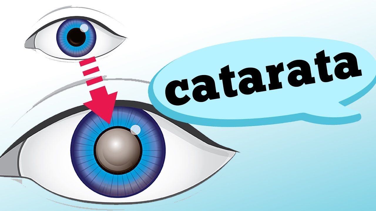 O QUE &Eacute; CATARATA E QUAIS SEUS SINTOMAS?