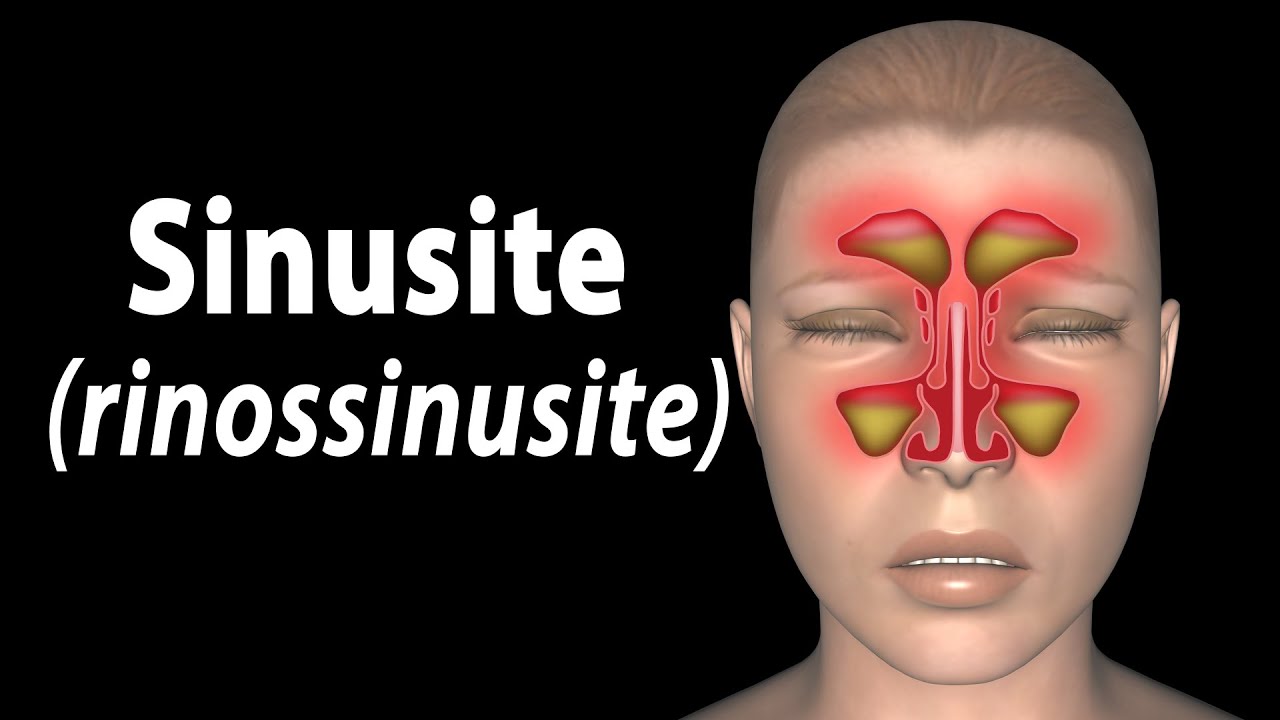 Sinusite, Animação. Alila Medical Media Português