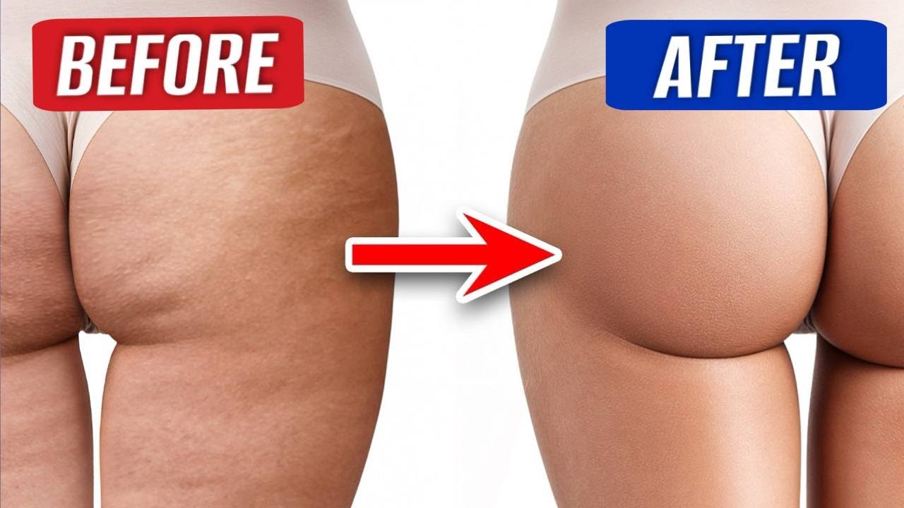 CELLULITE WILL BE GONE 🔥 How to eliminate cellulite WITHOUT SURGERY?