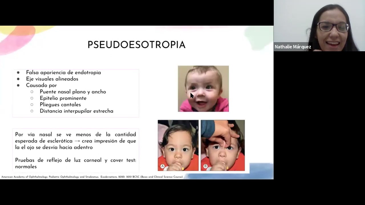 Endotropia infantil y acomodativa Dra. Nathalie Marquez