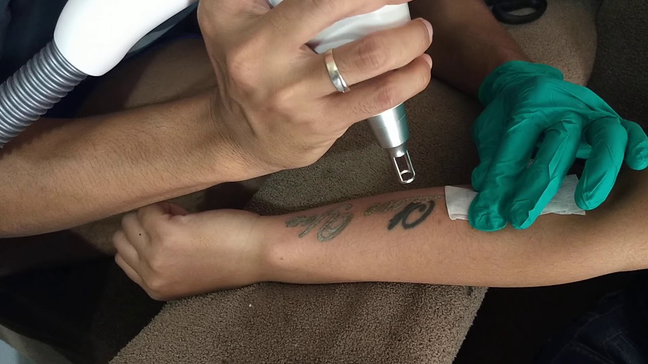 HAPUS TATTO PALING AMAN DENGAN LASER 🔥🔥🔥