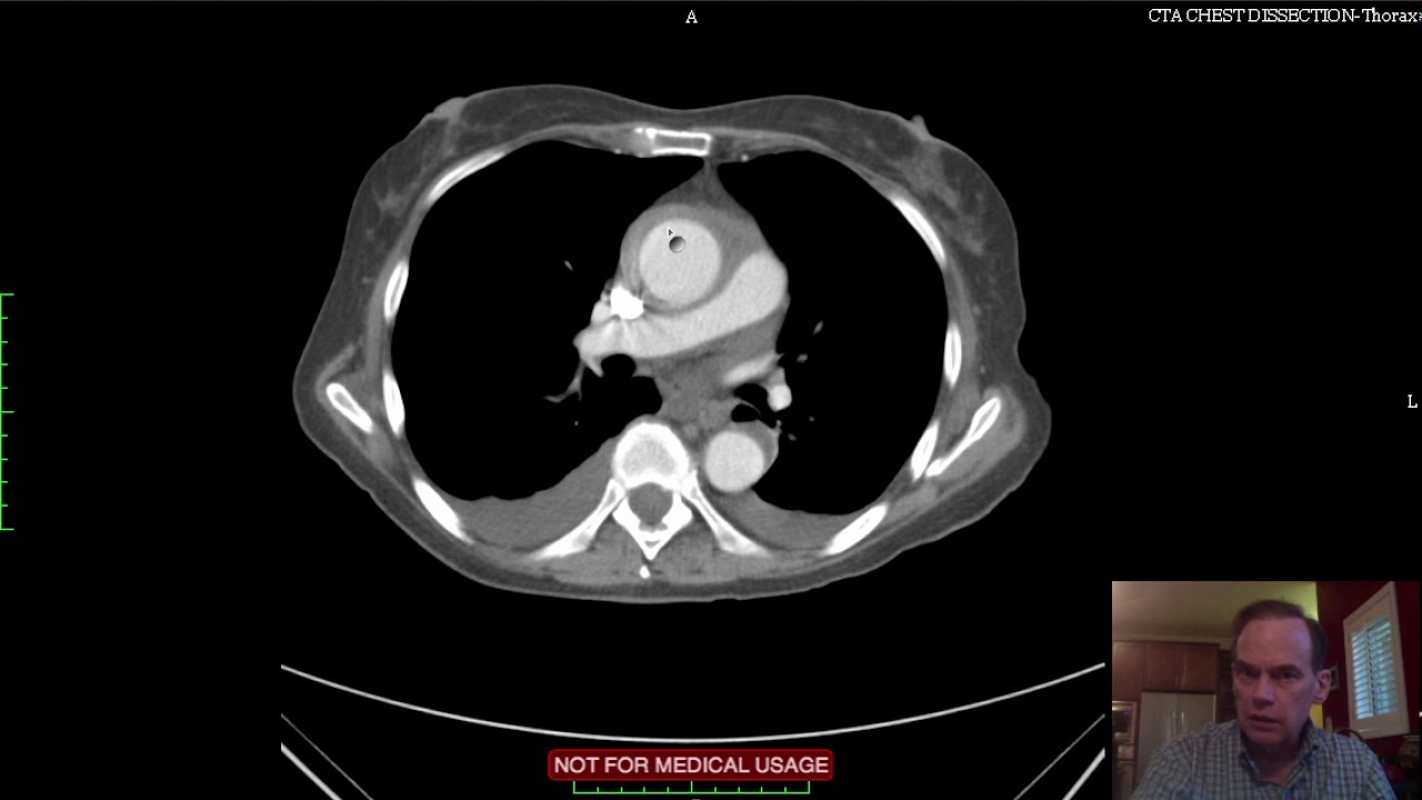 Aortic Mural Hematoma CT