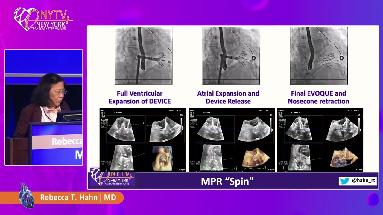 Advances in Imaging for Tricuspid Valve Intervention: Lessons Learned - Rebecca T Hahn, MD