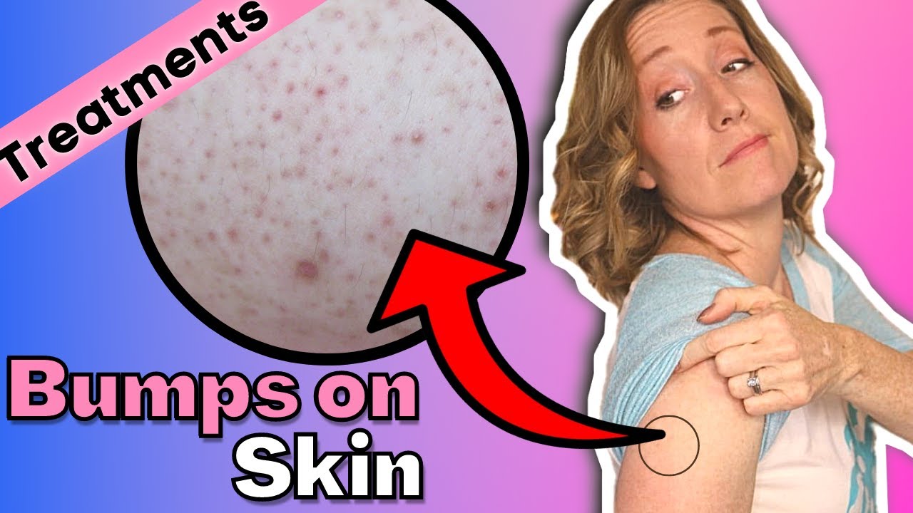 Red Bump on Your Arms | How to Treat Your Keratosis Pilaris at Home.