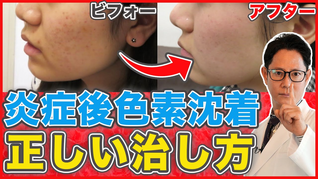 色素沈着は治せる？正しい改善方法と治し方を解説