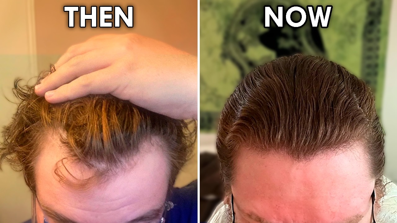 This Pill Stops Hair Loss And Regrows Your Hair (No Minoxidil)