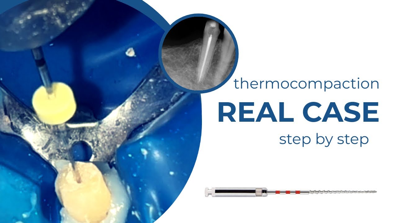 THERMOCOMPACTION TECHNIQUE Step by step real case