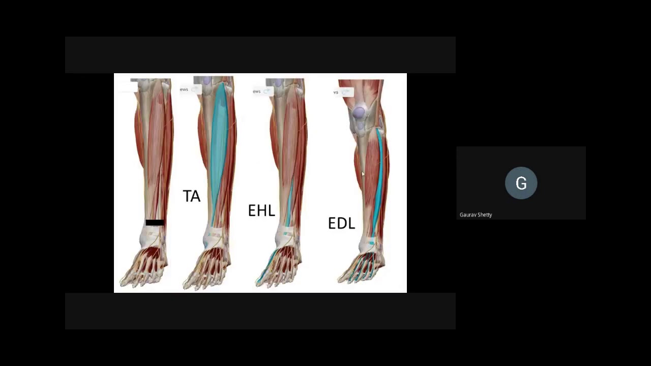 Plastiquest Case Discussion-Foot Drop 1