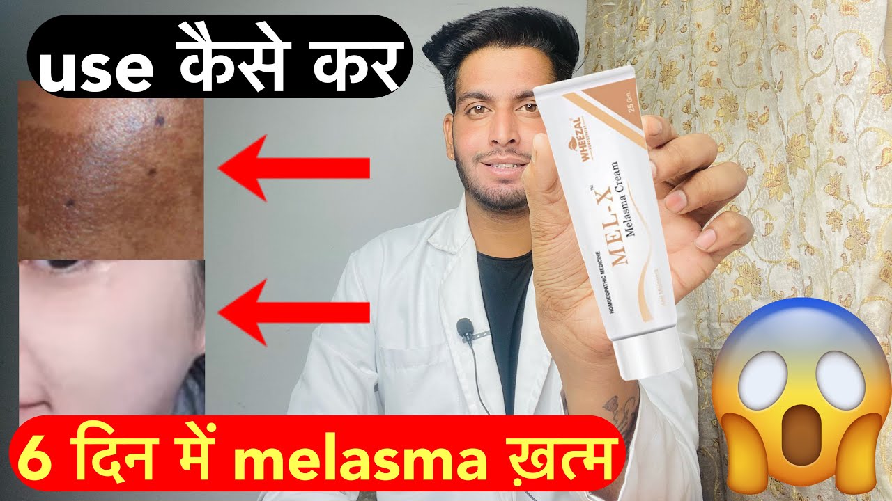 Лучший крем от мелазмы | Крем Mel x от мелазмы | Обзор крема Mel x от мелазмы | Применение крема ...