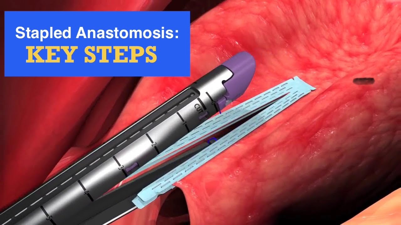 Stapled Anastomosis: Step-by-Step Technique, Tips, and Critical Pitfalls