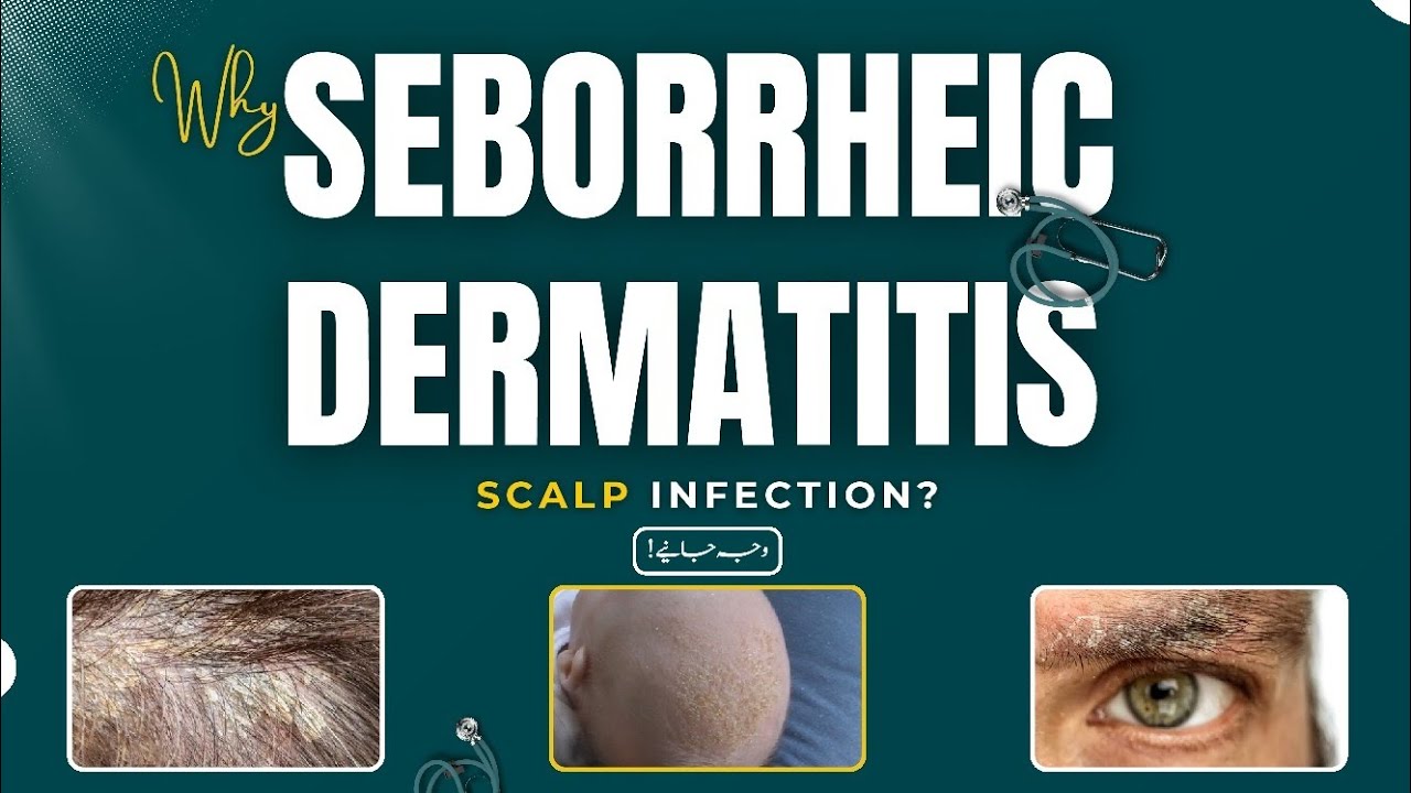 Seborrheic Dermatitis, Seborrheic Dermatitis Treatment