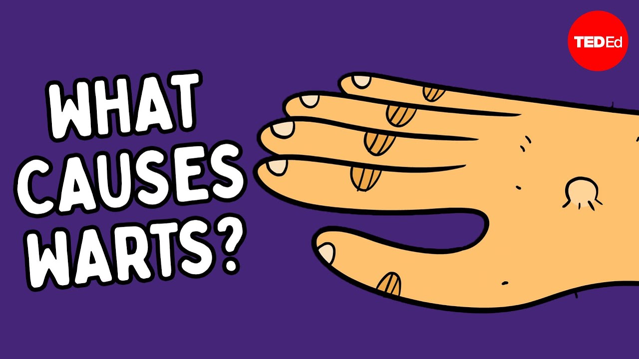 What are warts &mdash; and how do you get rid of them? - Cella Wright