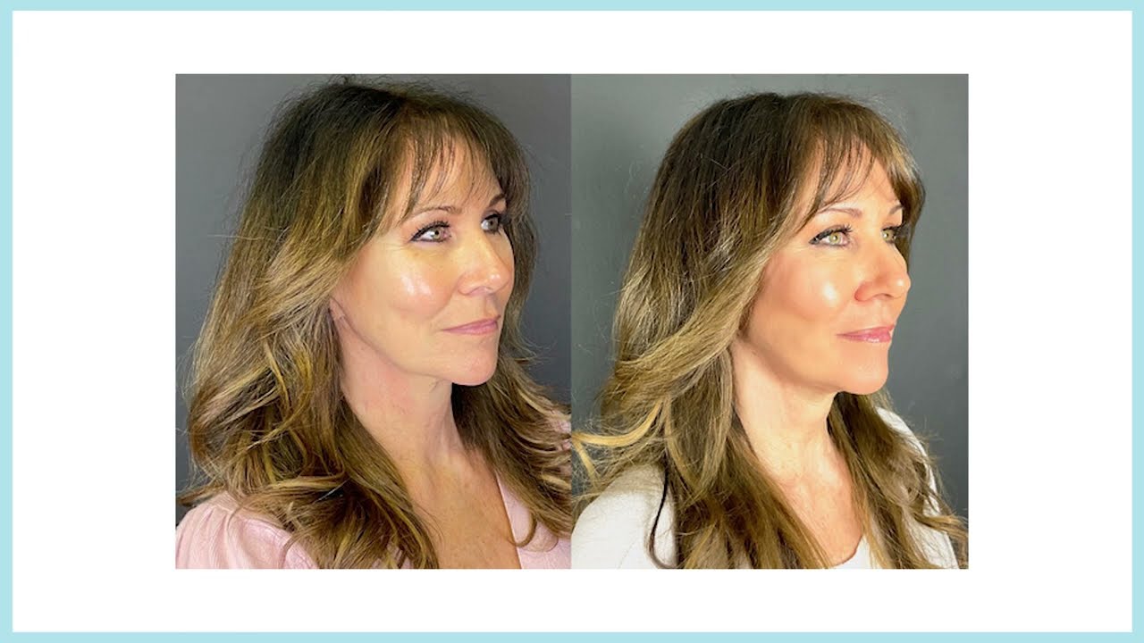 Tweak of the Week: Morpheus8 with Linda Lusardi at The Cosmetic Skin Clinic | Alice Hart-Davis