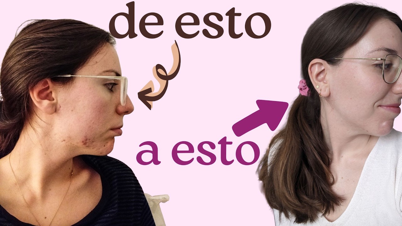 ACNÉ | Cómo lo eliminé sólo con cosméticos (piel grasa)
