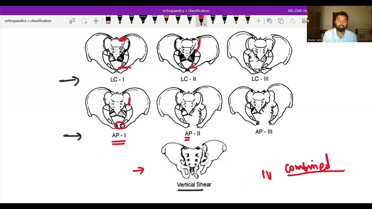 Young and Bergess | Tiles Classification | Pelvic fracture Classification