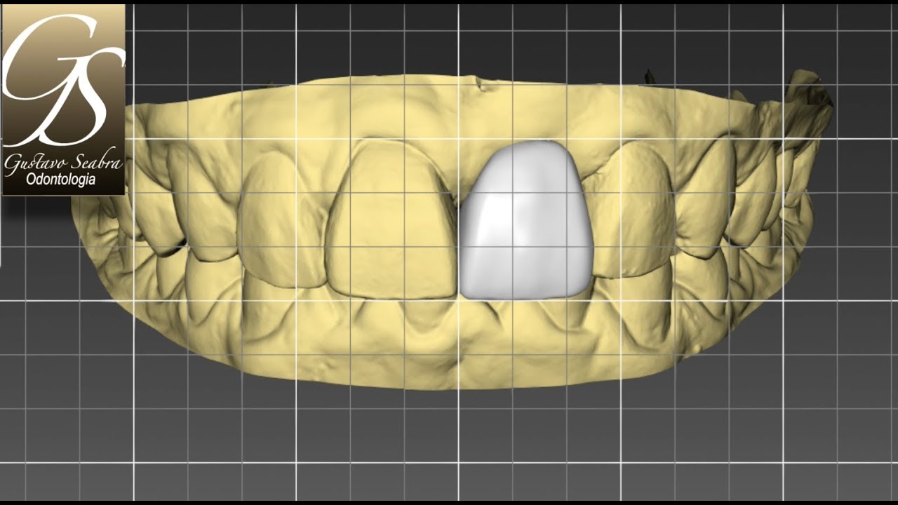 Fluxo Digital - Cerec In Lab - Caso Unit&aacute;rio - Refer&ecirc;ncia Biogen&eacute;rica