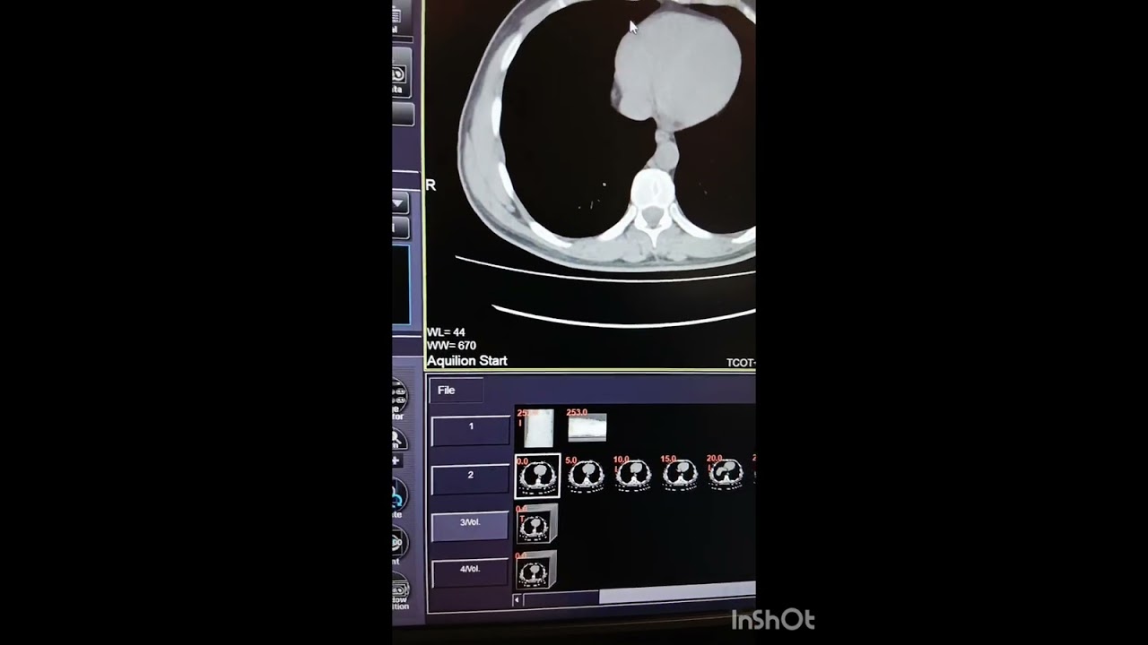 How to Change Patient Information and Use of Raw Data for volume formation 