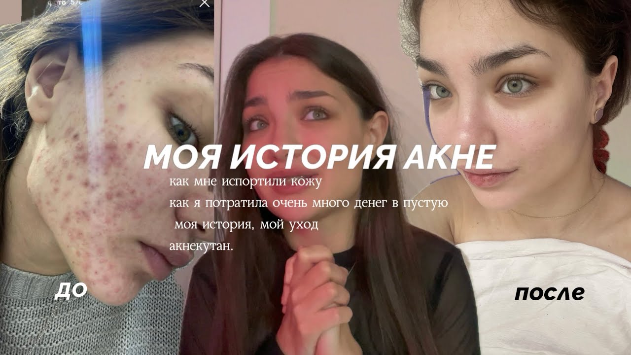 АКНЕКУТАН/ ВЫЛЕЧИЛА АКНЕ/ моя история лечения длиною в 8 лет / МНОГО ФОТО