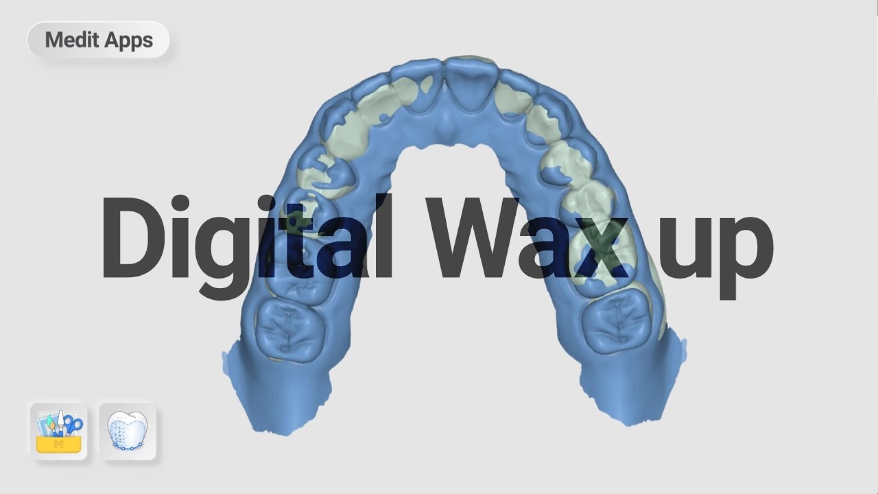 Designing temporary with digital wax up.
